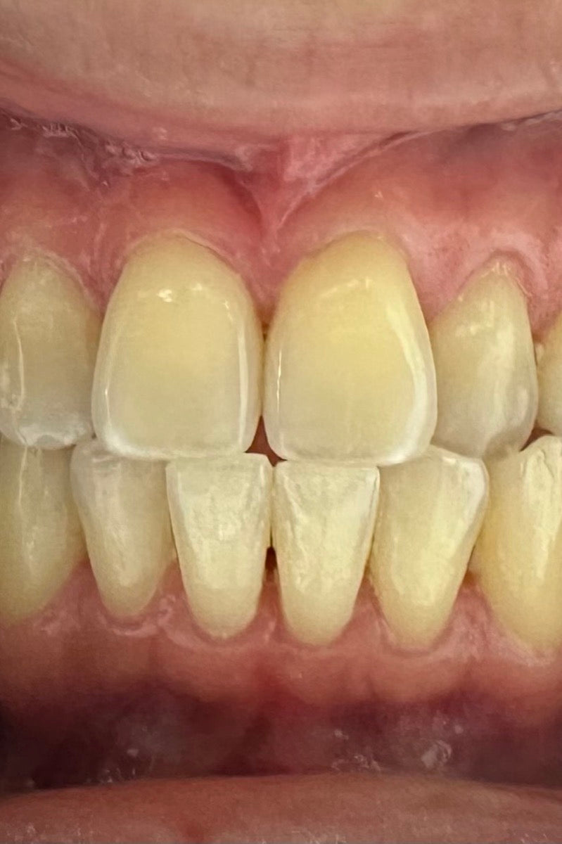 Crowded lower teeth, straightened, before treatment