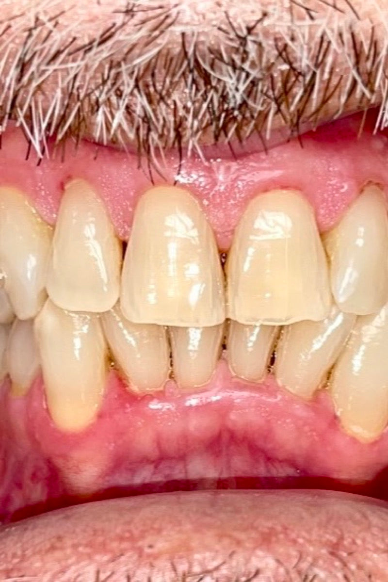 Lower anterior crowding, before treatment