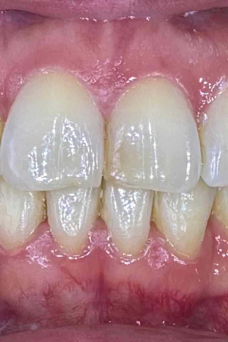 Upper anterior crowding, after treatment