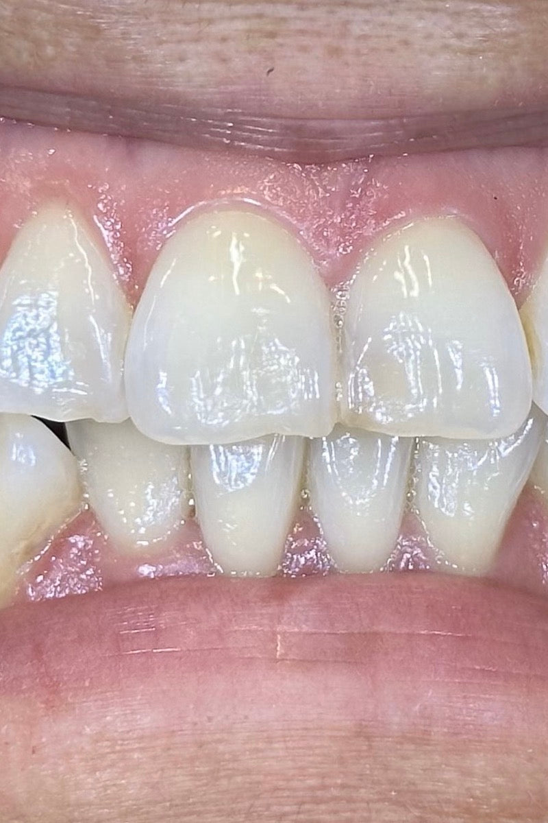 Upper anterior crowding, before treatment