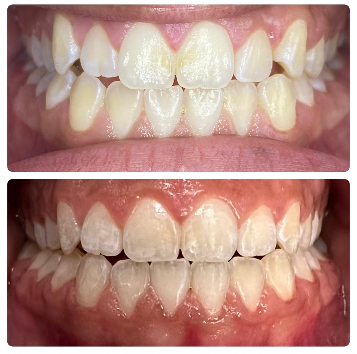 A treated TruAligner case, before and after